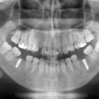 最新鋭の歯科用CT